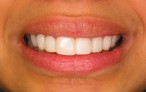 Glamsmile for Discoloured Teeth - after