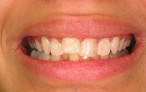 Glamsmile for Crooked Teeth - before