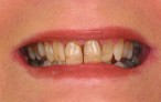 Glamsmile for Discoloured Teeth - before