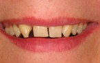 Glamsmile for Gappy Teeth - Before