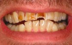 Glamsmile for Worn Down Teeth - before