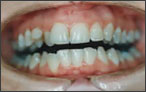Orthodontics for Crossbite - before