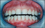 Orthodontics for Crossbite - after