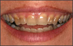 Cosmetic Dentistry for Discoloured Teeth - before