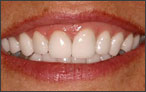 Cosmetic Dentistry for Discoloured Teeth - after