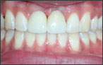 Cosmetic Dentistry for Missing Teeth - after