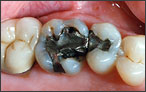 Replacing Old Silver Fillings - before