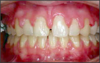 Orthodontics for Openbite - before
