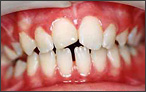 Orthodontics for Openbite - after
