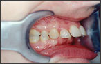 Orthodontics for Overbite - before