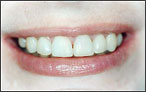 Orthodontics for Overbite - after