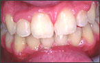 Orthodontics for Overcrowding - after