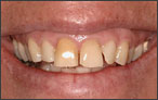 Cosmetic Dentistry for Spaces - before