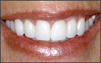 Cosmetic Dentistry for Spaces - after