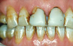 Cosmetic Dentistry Smile Makeovers - before